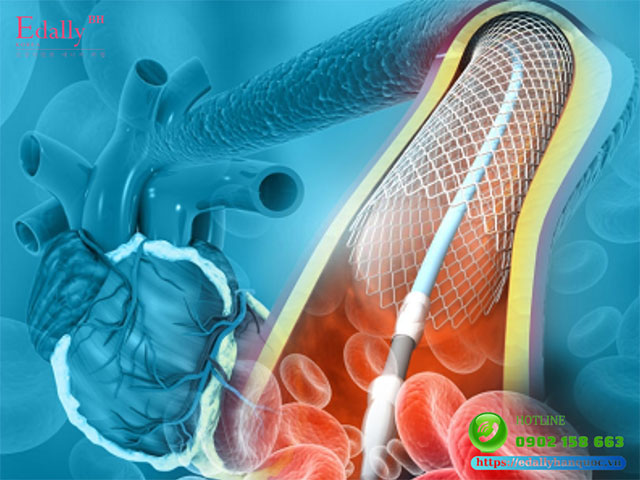 Đặt stent động mạch vành trên những bệnh nhân này bị hạn chế vì bất thường của lỗ vành và đường đi trong thành động mạch chủ chếnh nghiêng